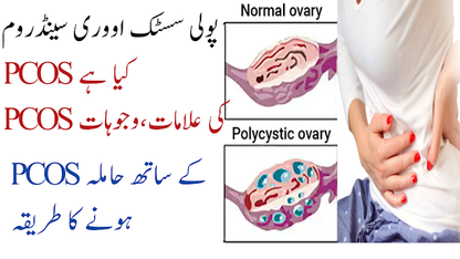 Ovary Cyst, Polycystic Syndrome, PCOS ka Khatma  اؤرین سسٹ، پولی سسٹک سینڈروم، PCOS,کا خاتمہ