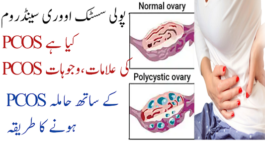 Ovary Cyst, Polycystic Syndrome, PCOS ka Khatma  اؤرین سسٹ، پولی سسٹک سینڈروم، PCOS,کا خاتمہ