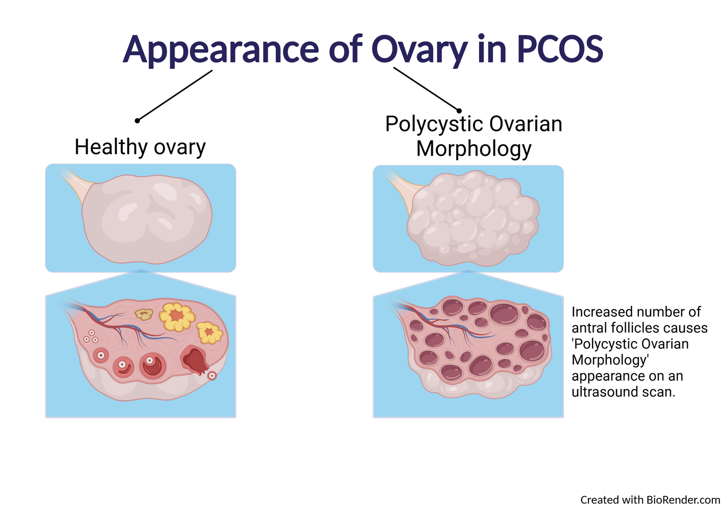Ovary Cyst, Polycystic Syndrome, PCOS ka Khatma  اؤرین سسٹ، پولی سسٹک سینڈروم، PCOS,کا خاتمہ