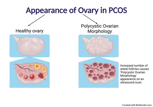 Ovary Cyst, Polycystic Syndrome, PCOS ka Khatma  اؤرین سسٹ، پولی سسٹک سینڈروم، PCOS,کا خاتمہ